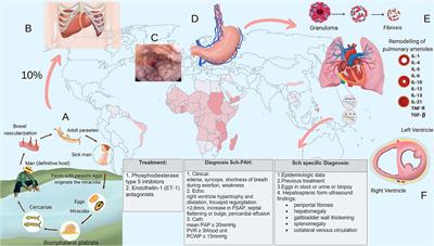 Schistosome-Associated Pulmonary Arterial Hypertension: A Review Emphasizing Pathogenesis